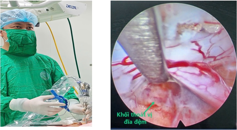 79 king 12 ĐA KHOA m.79king 32 SỐ 2: PHẪU THUẬT NỘI SOI  LẤY ĐĨA ĐỆM THOÁT VỊ, GIẢI ÉP ỐNG SỐNG THÀNH CÔNG  CHO 1179king com 65 TUỔI