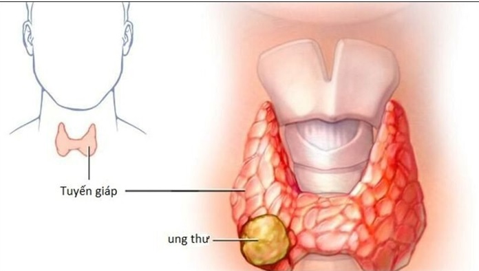 UNG THƯ TUYẾN GIÁP VÀ VAI TRÒ CỦA CHẨN ĐOÁN HÌNH ẢNH