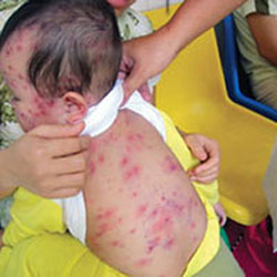 Dấu hiệu khi trẻ mắc sởi