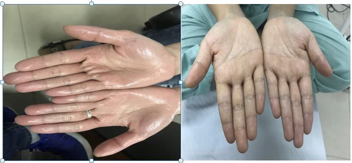 Tăng tiết mồ hôi tay do cường hệ thần kinh giao cảm